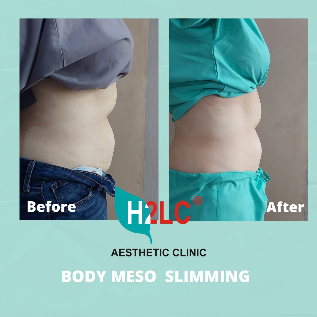 Hasil Suntik Slimming Perut